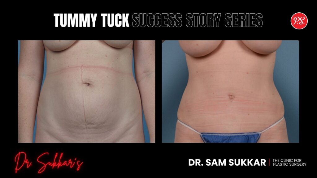 Houston Tummy Tuck: 42-Year-Old Mom's Confidence Reborn - Tummy Tuck Success Story Series in Houston, Texas by Dr. Sam Sukkar, MD