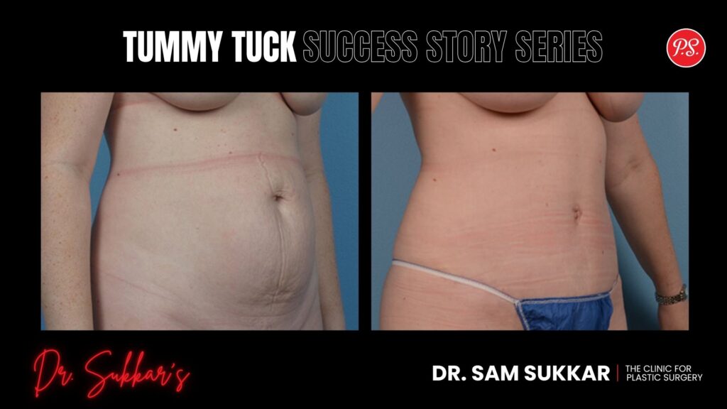 Houston Tummy Tuck: 42-Year-Old Mom's Confidence Reborn - Tummy Tuck Success Story Series in Houston, TX by Dr. Sam Sukkar, MD