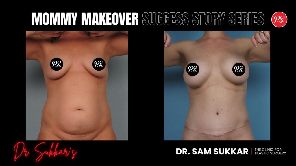 Mommy Makeover Referral Success: Houston Mom at 34 - Mommy Makeover Success Story Series in Houston, Texas by Dr. Sam Sukkar, MD