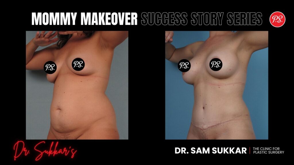 Mommy Makeover Referral Success: Houston Mom at 34 - Mommy Makeover Success Story Series in Houston, TX by Dr. Sam Sukkar, MD