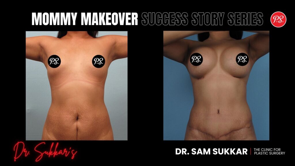 Petite Mommy Makeover: Houston Mom’s A to C Cup Journey - Mommy Makeover Success Story Series in Houston, Texas by Dr. Sam Sukkar, MD