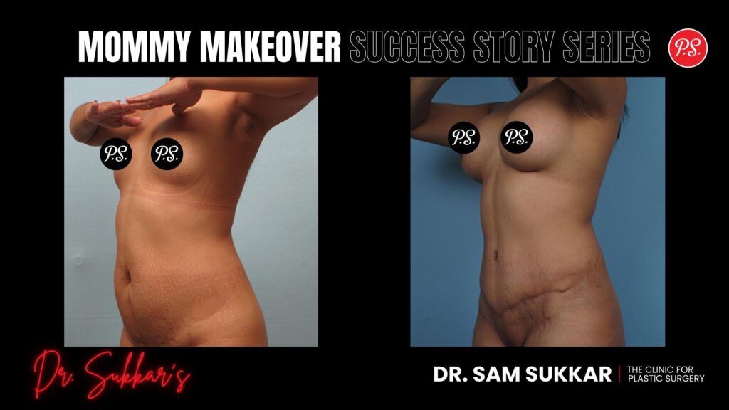 Petite Mommy Makeover: Houston Mom’s A to C Cup Journey - Mommy Makeover Success Story Series in Houston, TX by Dr. Sam Sukkar, MD