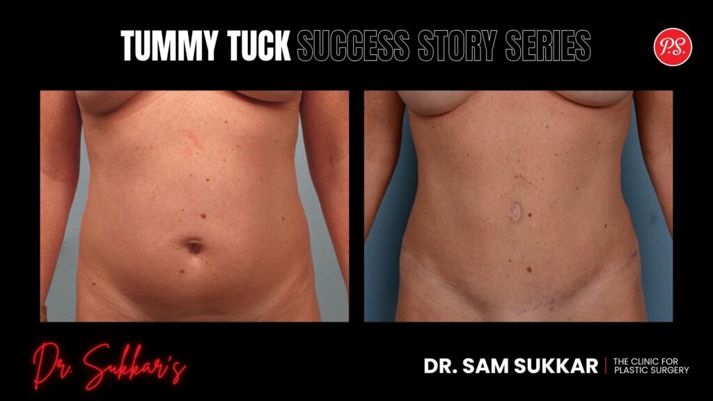 Tummy Tuck After Weight Loss: Houston Patient’s Journey - Tummy Tuck Success Story Series in Houston, Texas by Dr. Sam Sukkar, MD