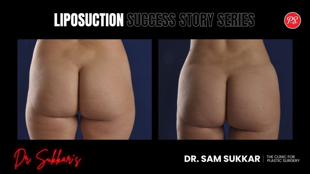 VASER Liposuction Houston: 32-Year-Old’s Targeted Transformation - Liposuction Success Story Series in Houston, Texas by Dr. Sam Sukkar, MD