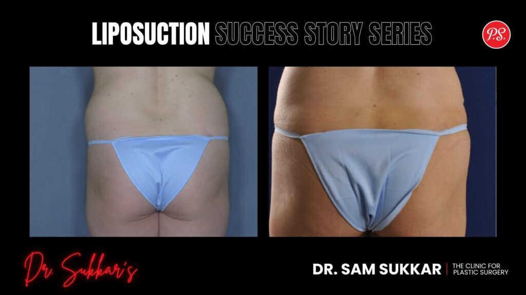 VASER Liposuction Success: 41-Year-Old’s Houston Journey - Liposuction Success Story Series in Houston, Texas by Dr. Sam Sukkar, MD