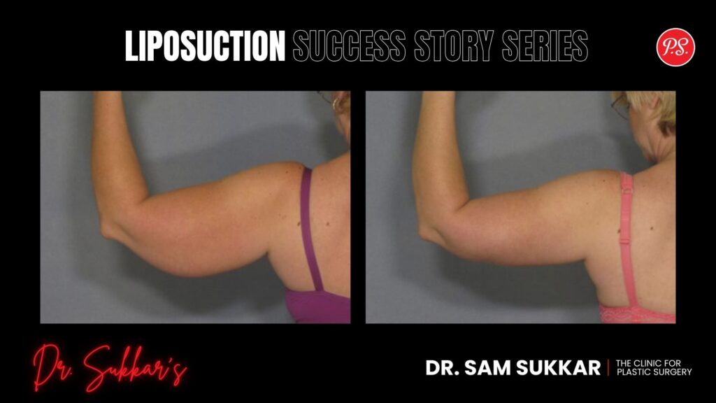 VASER Liposuction Transformation: Houston Woman's Journey - Liposuction Success Story Series in Houston, Texas by Dr. Sam Sukkar, MD