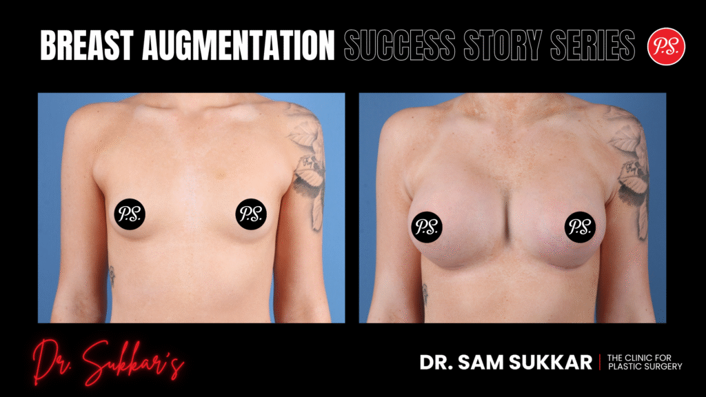 Breast Augmentation Success: Tall Frame Transformation in Houston - Breast Augmentation Success Story Series by Dr. Sam Sukkar, MD in Houston, TX