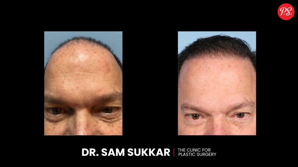 Hair Transplant Before and After Transformations by Dr. Sam Sukkar, MD in Houston, TX