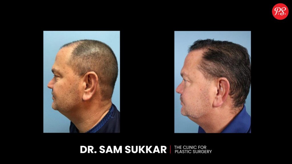 Hair Transplant Before and After Transformations by Dr. Sam Sukkar, MD in Houston, Texas