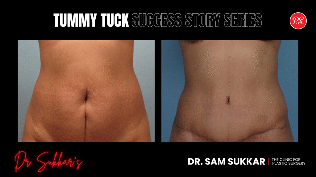 Tummy Tuck After Breast Augmentation: Houston Mom’s Story - Tummy Tuck Success Story Series by Dr. Sam Sukkar, MD in Houston, Texas