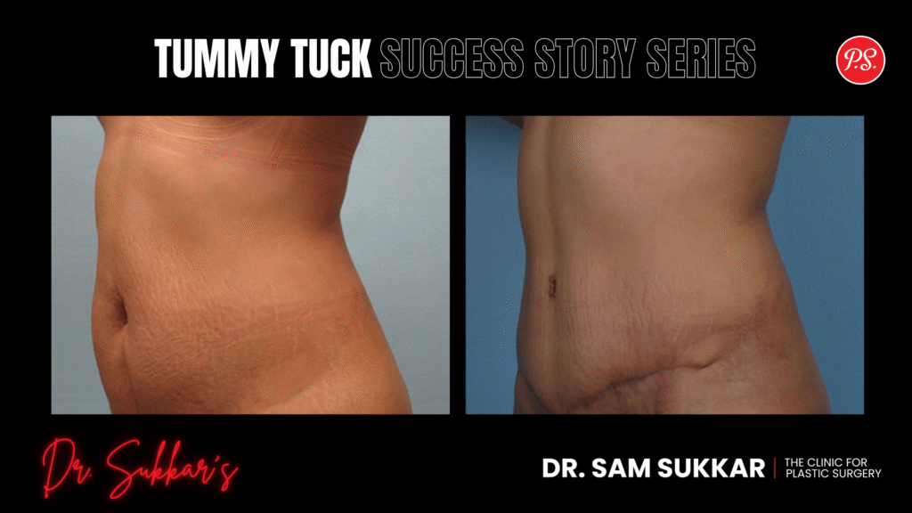 Tummy Tuck After Breast Augmentation: Houston Mom’s Story - Tummy Tuck Success Story Series by Dr. Sam Sukkar, MD in Houston, TX
