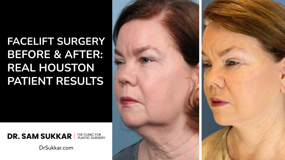 Facelift Before and After: Real Houston Patient Results