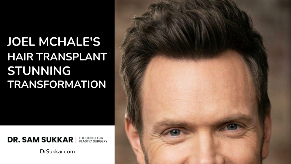 Joel McHale’s Hair Transplant Stunning Transformation