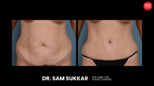 Apron Belly Before and After Pictures: Shocking Changes | Houston ...