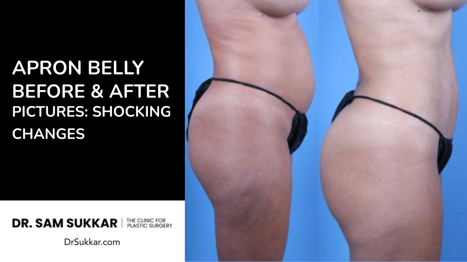 Apron Belly Before and After Pictures: Shocking Changes