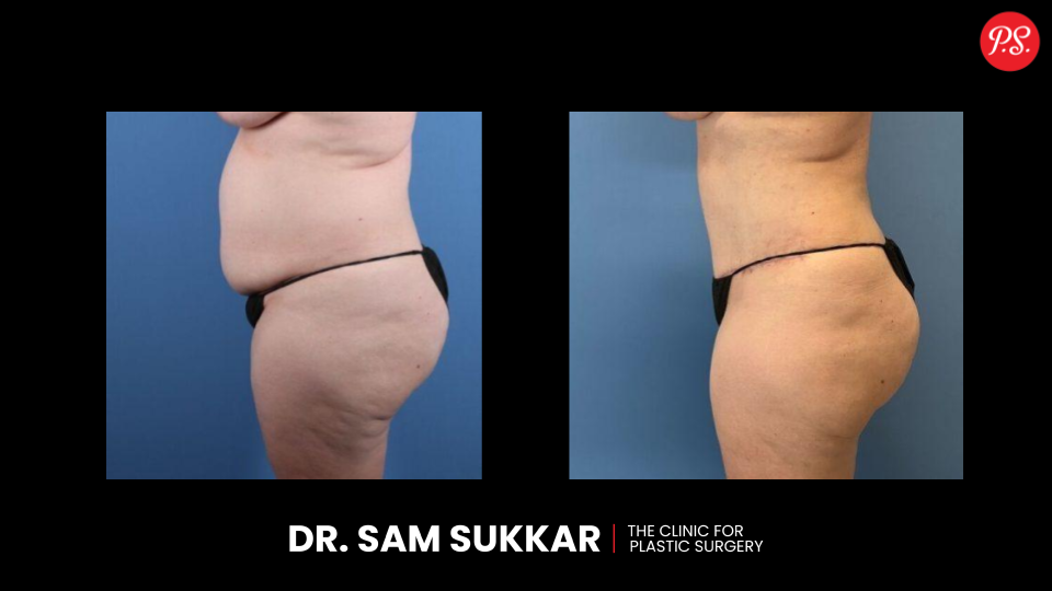 Compression Garment for Apron Belly: Support and Shape by Dr. Sam Sukkar, MD in Houston, Texas