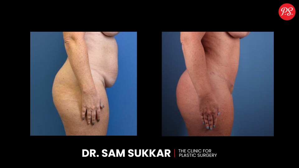 Compression Garment for Apron Belly: Support and Shape in Houston, TX
