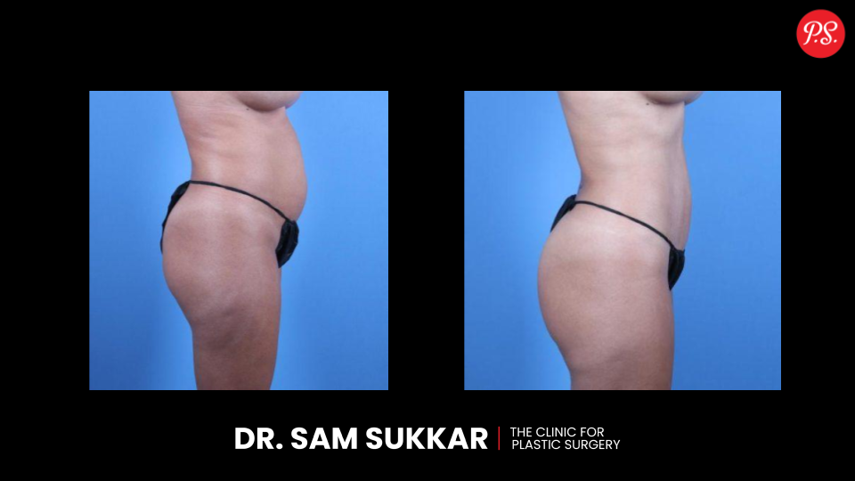 Compression Garment for Apron Belly: Support and Shape by Dr. Sam Sukkar, MD in Houston, TX