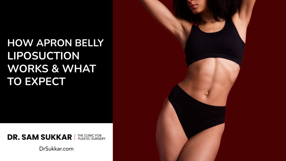 How Apron Belly Liposuction Works and What to Expect
