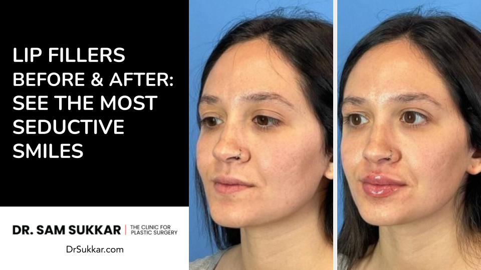 Lip Filler Before and After: See The Most Seductive Smiles