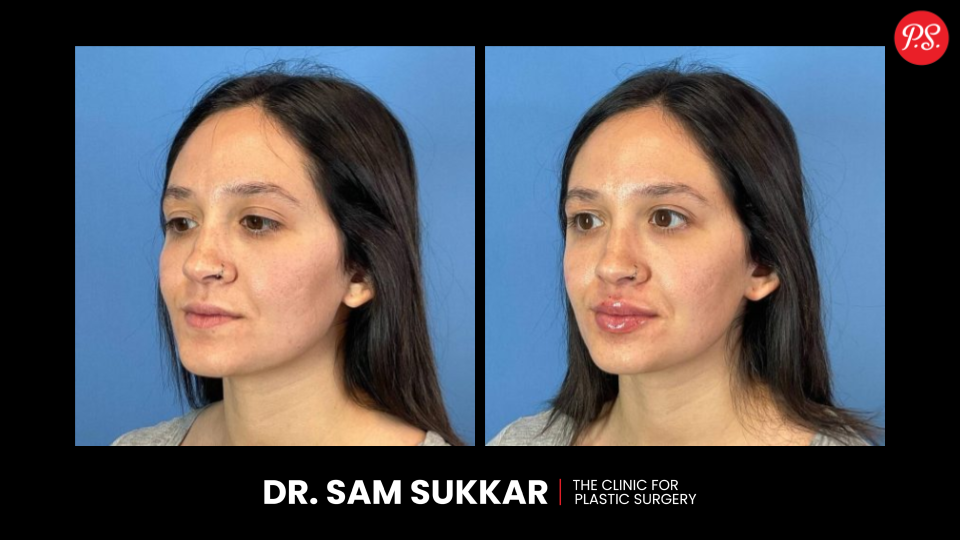 Lip Filler Before and After in Houston, Texas by Dr. Sam Sukkar, MD