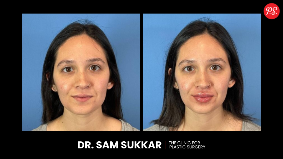 Lip Filler Before and After in Houston, TX by Dr. Sam Sukkar, MD