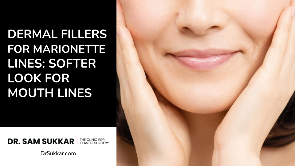 Dermal Fillers for Marionette Lines: Softer Look for Mouth Lines