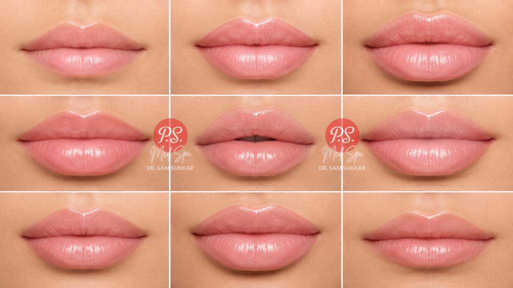 Lip Filler Shapes available in Houston, Texas