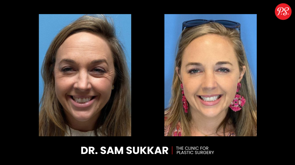 Botox Before and After Photos Results in Houston, Texas