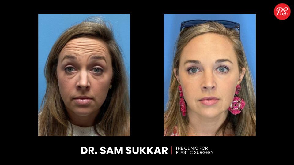 Botox Before and After Results in Houston, Texas