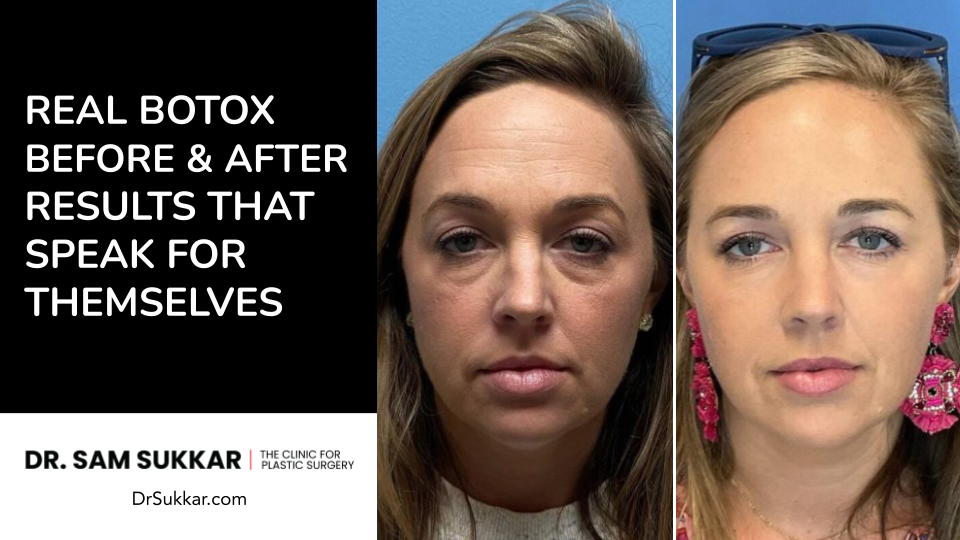 Real Botox Before and After Results by Dr. Sam Sukkar, MD