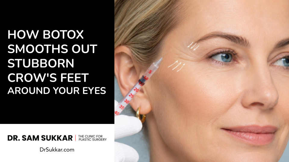 How Botox Smooths Out Stubborn Crow’s Feet Around Your Eyes