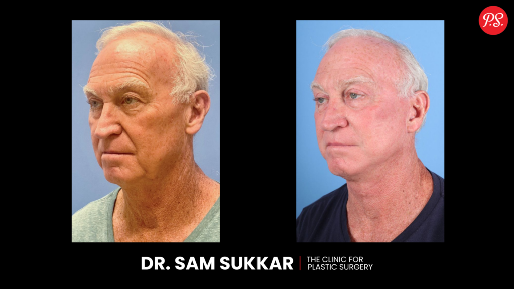 Deep Plane Facelift Before and After Photos in Houston, TX
