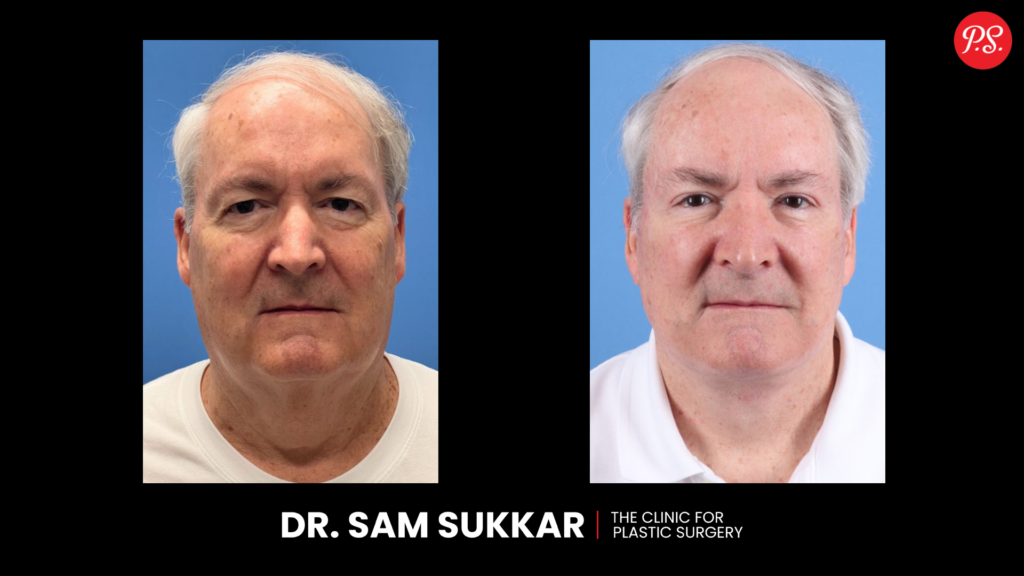 Deep Plane Facelift Before and After in Houston, TX