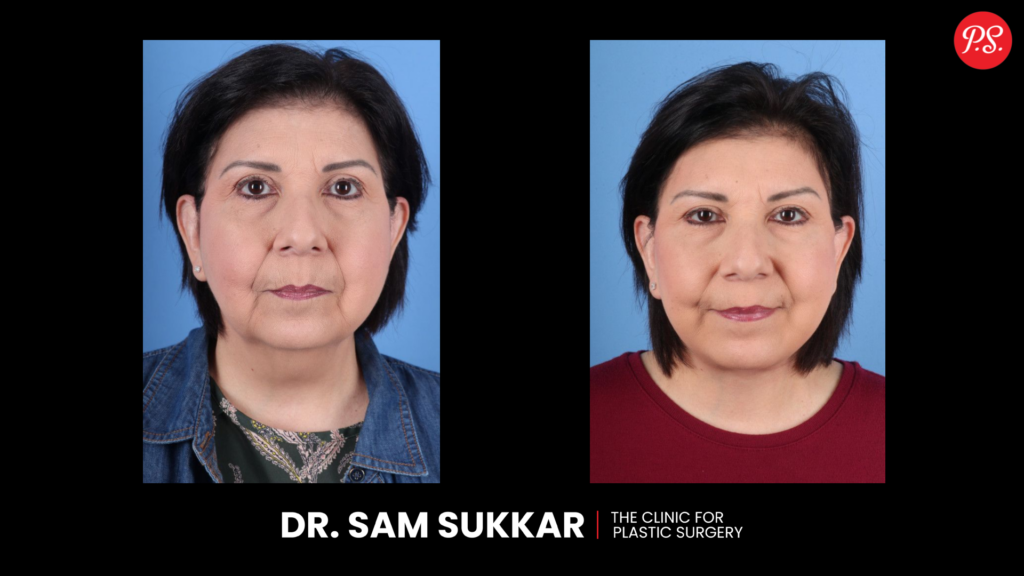 Deep Plane Facelift Procedure Before and After in Houston, TX