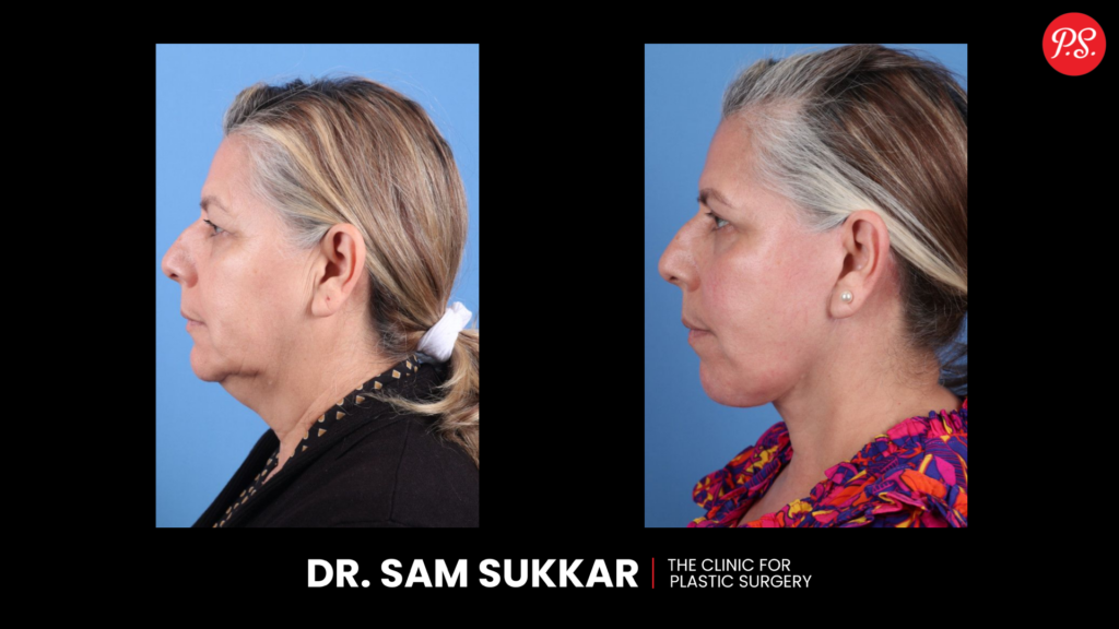 Deep Plane Facelift Surgery Before and After in Houston, TX