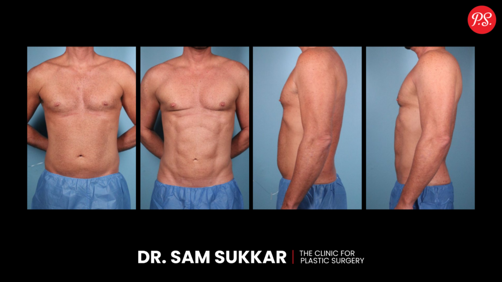 High Definition Liposuction Before and After Photo Gallery In Houston, Texas