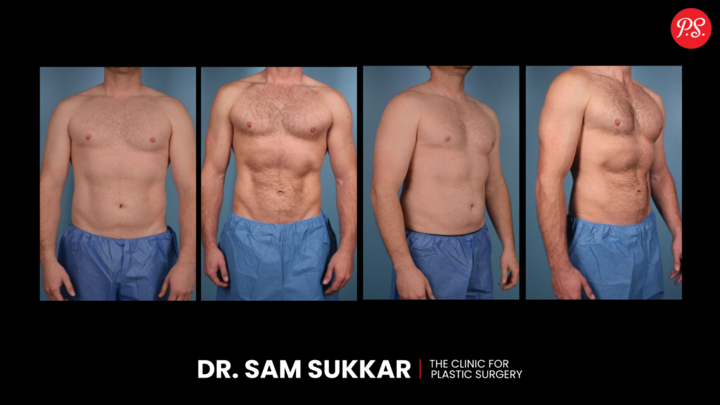 High Definition Liposuction Before and After Gallery In Houston, Texas