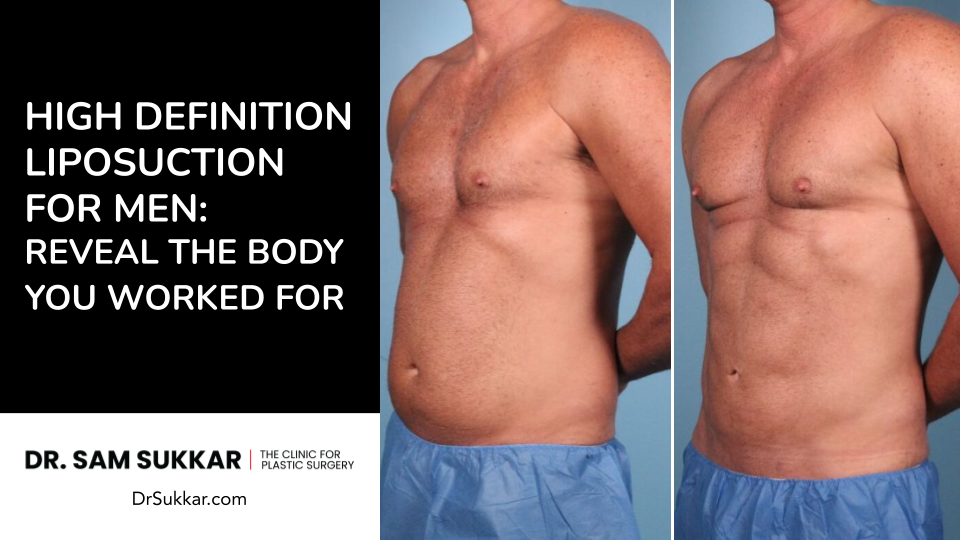 High Definition Liposuction for Men: Reveal the Body You Worked For by Dr. Sam Sukkar, MD
